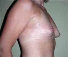 Breast Augmentation Before Photo by Stanley Castor, MD; Tampa, FL - Case 39265