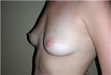 Breast Augmentation Before Photo by Stanley Castor, MD; Tampa, FL - Case 39266