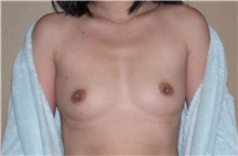 Breast Augmentation Before Photo by Stanley Castor, MD; Tampa, FL - Case 39267