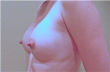 Breast Augmentation After Photo by Stanley Castor, MD; Tampa, FL - Case 39267