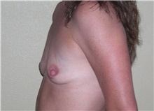 Breast Augmentation Before Photo by Stanley Castor, MD; Tampa, FL - Case 39268
