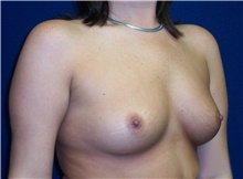 Breast Augmentation Before Photo by Stanley Castor, MD; Tampa, FL - Case 39269