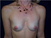 Breast Augmentation Before Photo by Stanley Castor, MD; Tampa, FL - Case 39270