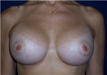 Breast Augmentation After Photo by Stanley Castor, MD; Tampa, FL - Case 39271