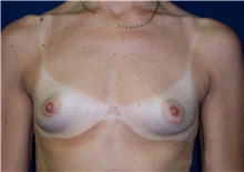 Breast Augmentation Before Photo by Stanley Castor, MD; Tampa, FL - Case 39271