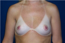 Breast Augmentation Before Photo by Stanley Castor, MD; Tampa, FL - Case 39272