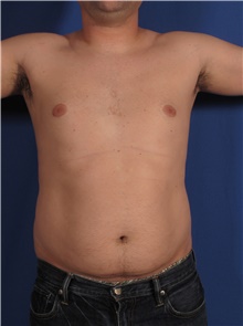 Liposuction Before Photo by Stanley Castor, MD; Tampa, FL - Case 39275