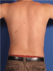 Liposuction After Photo by Stanley Castor, MD; Tampa, FL - Case 39275