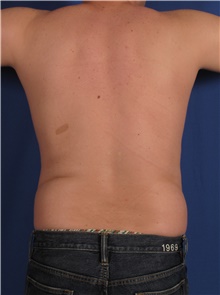 Liposuction Before Photo by Stanley Castor, MD; Tampa, FL - Case 39275