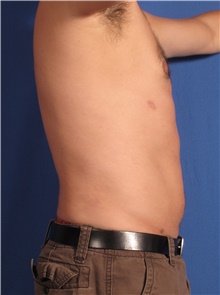 Liposuction After Photo by Stanley Castor, MD; Tampa, FL - Case 39275