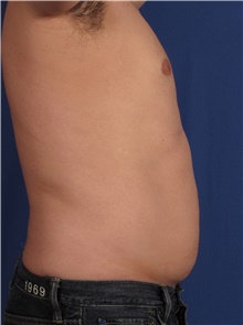 Liposuction Before Photo by Stanley Castor, MD; Tampa, FL - Case 39275