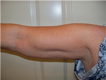 Liposuction After Photo by Stanley Castor, MD; Tampa, FL - Case 39278