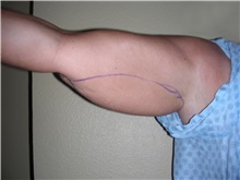 Liposuction Before Photo by Stanley Castor, MD; Tampa, FL - Case 39278