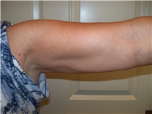 Liposuction After Photo by Stanley Castor, MD; Tampa, FL - Case 39278