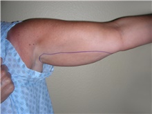 Liposuction Before Photo by Stanley Castor, MD; Tampa, FL - Case 39278