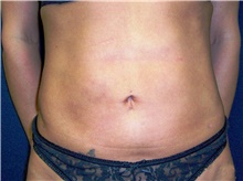 Liposuction After Photo by Stanley Castor, MD; Tampa, FL - Case 39289