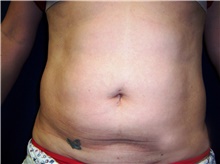 Liposuction Before Photo by Stanley Castor, MD; Tampa, FL - Case 39289