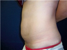 Liposuction Before Photo by Stanley Castor, MD; Tampa, FL - Case 39289
