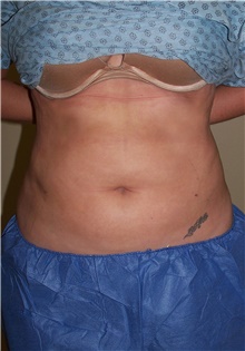 Liposuction After Photo by Stanley Castor, MD; Tampa, FL - Case 39292