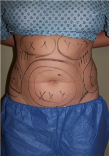 Liposuction Before Photo by Stanley Castor, MD; Tampa, FL - Case 39292