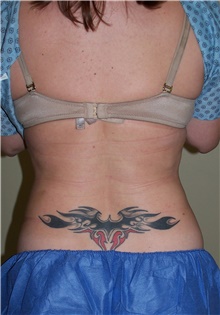 Liposuction After Photo by Stanley Castor, MD; Tampa, FL - Case 39292