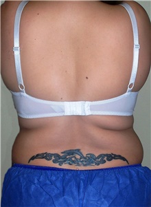 Liposuction After Photo by Stanley Castor, MD; Tampa, FL - Case 39295