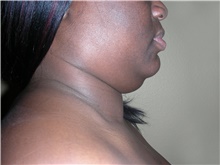 Liposuction Before Photo by Stanley Castor, MD; Tampa, FL - Case 39299