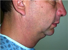 Liposuction Before Photo by Stanley Castor, MD; Tampa, FL - Case 39300