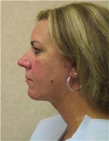 Liposuction After Photo by Stanley Castor, MD; Tampa, FL - Case 39301