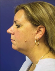 Liposuction Before Photo by Stanley Castor, MD; Tampa, FL - Case 39301