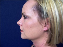 Liposuction After Photo by Stanley Castor, MD; Tampa, FL - Case 39302