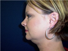 Liposuction Before Photo by Stanley Castor, MD; Tampa, FL - Case 39302