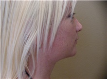 Liposuction After Photo by Stanley Castor, MD; Tampa, FL - Case 39303