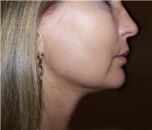 Liposuction After Photo by Stanley Castor, MD; Tampa, FL - Case 39305