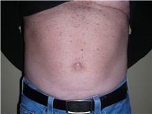 Liposuction After Photo by Stanley Castor, MD; Tampa, FL - Case 39306