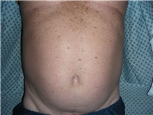 Liposuction Before Photo by Stanley Castor, MD; Tampa, FL - Case 39306