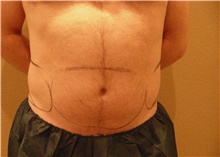 Liposuction Before Photo by Stanley Castor, MD; Tampa, FL - Case 39307