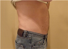 Liposuction After Photo by Stanley Castor, MD; Tampa, FL - Case 39307
