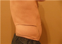 Liposuction Before Photo by Stanley Castor, MD; Tampa, FL - Case 39307