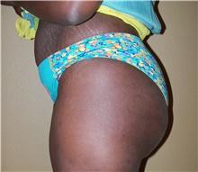 Buttock Lift with Augmentation Before Photo by Stanley Castor, MD; Tampa, FL - Case 39312