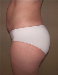 Buttock Lift with Augmentation After Photo by Stanley Castor, MD; Tampa, FL - Case 39313