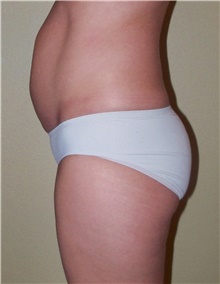 Buttock Lift with Augmentation Before Photo by Stanley Castor, MD; Tampa, FL - Case 39313