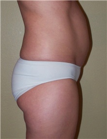 Buttock Lift with Augmentation Before Photo by Stanley Castor, MD; Tampa, FL - Case 39313