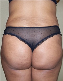 Buttock Lift with Augmentation After Photo by Stanley Castor, MD; Tampa, FL - Case 39314