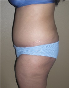 Buttock Lift with Augmentation Before Photo by Stanley Castor, MD; Tampa, FL - Case 39314