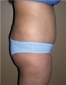 Buttock Lift with Augmentation Before Photo by Stanley Castor, MD; Tampa, FL - Case 39314