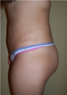 Buttock Lift with Augmentation After Photo by Stanley Castor, MD; Tampa, FL - Case 39315
