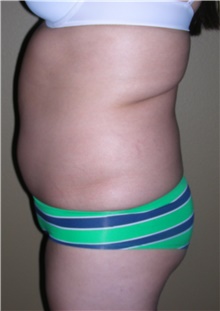 Buttock Lift with Augmentation Before Photo by Stanley Castor, MD; Tampa, FL - Case 39315