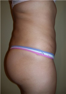 Buttock Lift with Augmentation After Photo by Stanley Castor, MD; Tampa, FL - Case 39315