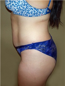 Buttock Lift with Augmentation Before Photo by Stanley Castor, MD; Tampa, FL - Case 39316